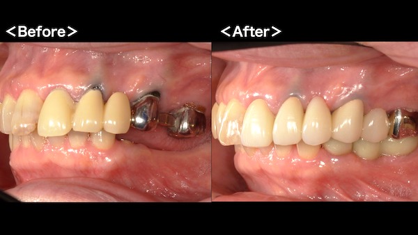 港南台パーク歯科クリニック｜ブログ｜【症例】保険診療で、できる限り白いブリッジに｜治療前後の比較画像