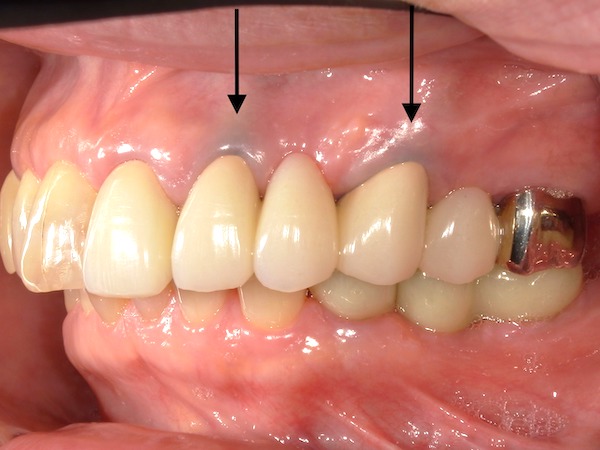 港南台パーク歯科クリニック｜ブログ｜【症例】保険診療で、できる限り白いブリッジに｜金属で黒ずんだ歯茎の画像