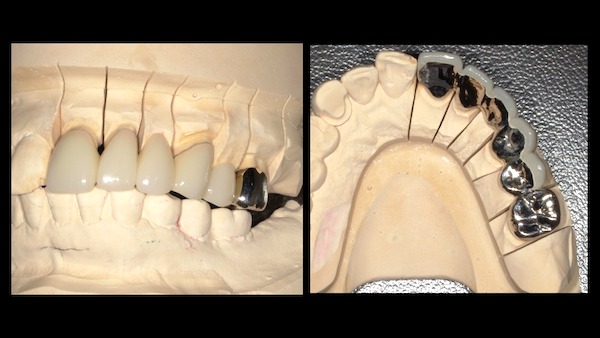 港南台パーク歯科クリニック｜ブログ｜【症例】保険診療で、できる限り白いブリッジに｜治療詳細の画像