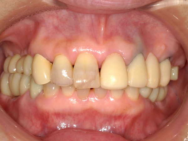 港南台パーク歯科クリニック｜ブログ｜【症例】保険診療で、できる限り白いブリッジに｜仮歯を入れた画像2