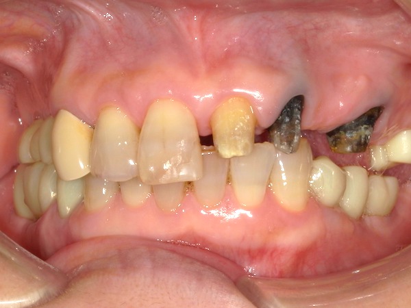 港南台パーク歯科クリニック｜ブログ｜【症例】保険診療で、できる限り白いブリッジに｜型取りを行う際の画像2