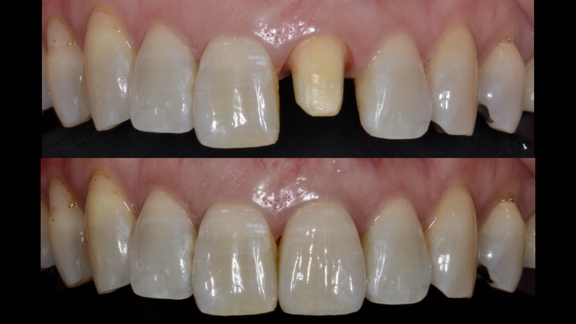 【症例】ジルコニアセラミックで自然な前歯を！｜港南台パーク歯科クリニック