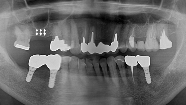 港南台パーク歯科クリニック｜症例｜【症例】他院で断られたインプラント治療（ソケットリフト）｜治療前のレントゲン