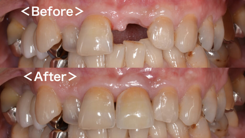 港南台パーク歯科クリニック｜症例｜【症例】インプラントによる前歯の審美治療｜アイキャッチ画像