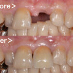 港南台パーク歯科クリニック｜症例｜【症例】インプラントによる前歯の審美治療｜アイキャッチ画像