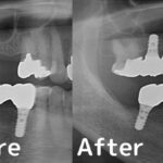 港南台パーク歯科クリニック｜症例｜【症例】他院で断られたインプラント治療（ソケットリフト）｜ビフォーアフター