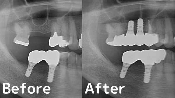 港南台パーク歯科クリニック｜症例｜【症例】他院で断られたインプラント治療（ソケットリフト）｜ビフォーアフター
