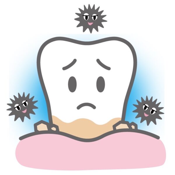 港南台パーク歯科クリニック｜歯科衛生士ブログ｜歯石には種類がある？隠れ歯石とは？｜細菌や歯石が歯に影響をおよぼずイメージ