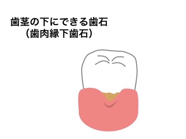 港南台パーク歯科クリニック｜歯科衛生士ブログ｜歯石には種類がある？隠れ歯石とは？｜歯肉縁下歯石