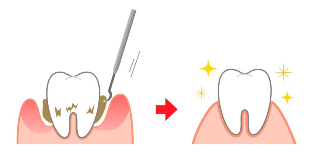 港南台パーク歯科クリニック｜歯科衛生士ブログ｜歯石には種類がある？隠れ歯石とは？｜アイキャッチ画像