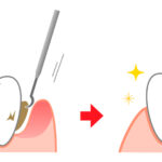 港南台パーク歯科クリニック｜歯科衛生士ブログ｜歯石には種類がある？隠れ歯石とは？｜アイキャッチ画像