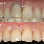 港南台パーク歯科クリニック｜症例｜【症例】グラグラになった前歯のインプラント治療(ジルコニアセラミック修復)｜ビフォーアフター