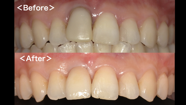 港南台パーク歯科クリニック｜症例｜【症例】グラグラになった前歯のインプラント治療(ジルコニアセラミック修復)｜ビフォーアフター