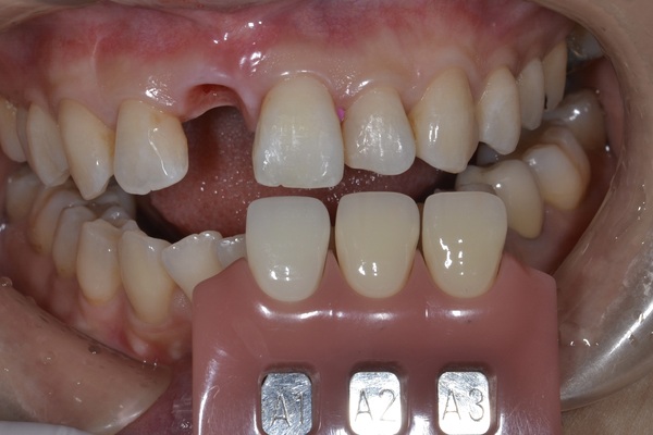 港南台パーク歯科クリニック｜症例｜【症例】グラグラになった前歯のインプラント治療(ジルコニアセラミック修復)｜色合わせ