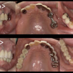 港南台パーク歯科クリニック｜症例｜【症例】失った奥歯のインプラントで何でも噛める歯を取り戻す！｜ビフォーアフター