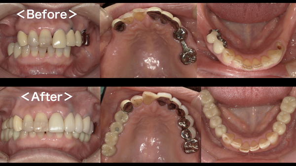 港南台パーク歯科クリニック｜症例｜【症例】失った奥歯のインプラントで何でも噛める歯を取り戻す！｜ビフォーアフター