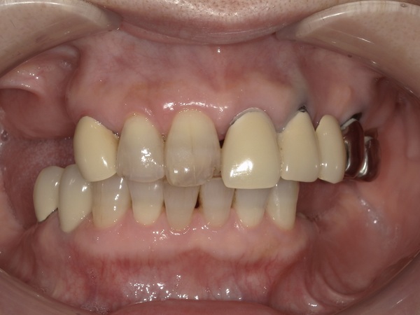 港南台パーク歯科クリニック｜症例｜【症例】失った奥歯のインプラントで何でも噛める歯を取り戻す！｜治療前