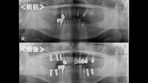港南台パーク歯科クリニック｜症例｜【症例】失った奥歯をインプラントで何でも噛める歯に戻す｜レントゲンの手術前後