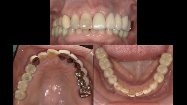 港南台パーク歯科クリニック｜症例｜【症例】失った奥歯のインプラントで何でも噛める歯を取り戻す！｜治療後