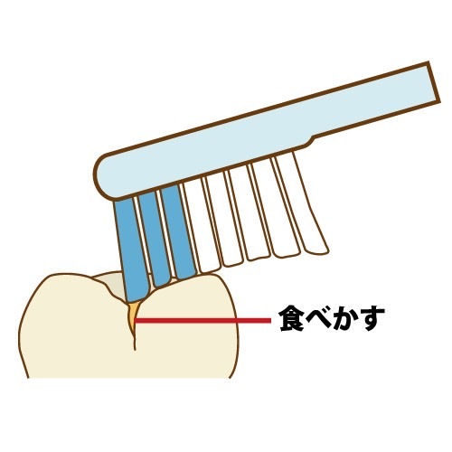 港南台パーク歯科｜歯科衛生士ブログ｜乳歯の虫歯が永久歯に及ぼす影響とは？｜乳歯は形態的に不潔域ができやすい