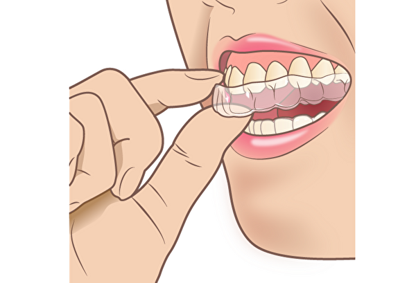 港南台パーク歯科クリニック｜ブログ｜顎が痛い！顎関節症とは｜ナイトガード画像