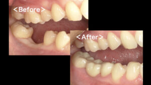 【症例】奥歯の欠損に対するジルコニアブリッジ修復