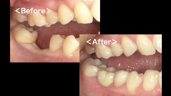 港南台パーク歯科クリニック｜症例｜【症例】奥歯の欠損に対するジルコニアブリッジ修復｜アイキャッチ