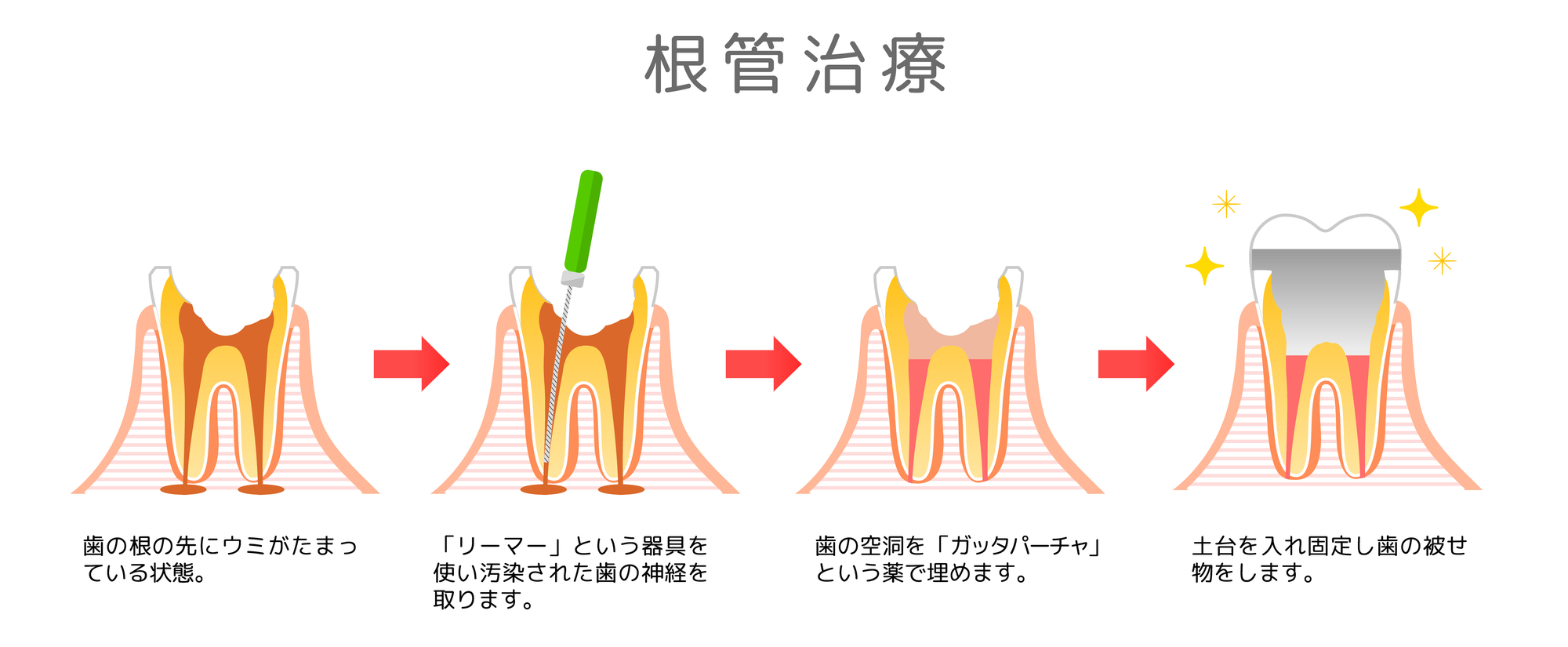 精密根管治療相談のご案内｜港南台パーク歯科クリニック｜根管治療の流れ