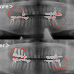 港南台パーク歯科クリニック｜症例｜【症例】インプラントの奥歯でしっかり噛める喜びを！｜アイキャッチ画像