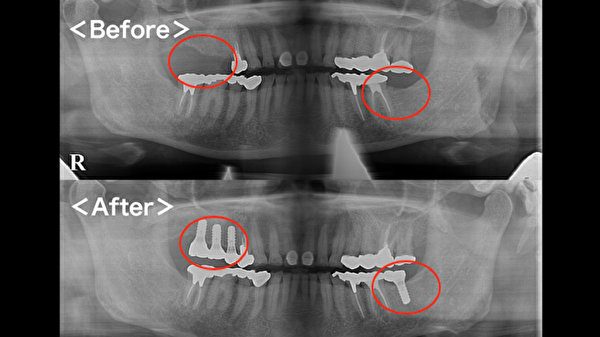 港南台パーク歯科クリニック｜症例｜【症例】インプラントの奥歯でしっかり噛める喜びを！｜アイキャッチ画像