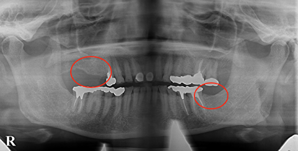 港南台パーク歯科クリニック｜症例｜【症例】インプラントの奥歯でしっかり噛める喜びを！｜治療前レントゲン写真