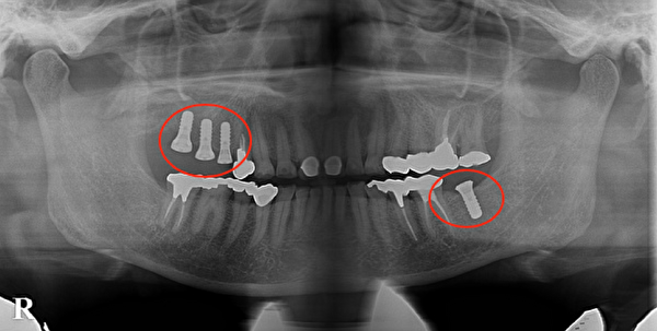 港南台パーク歯科クリニック｜症例｜【症例】インプラントの奥歯でしっかり噛める喜びを！｜術後のレントゲン写真