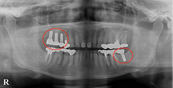 港南台パーク歯科クリニック｜症例｜【症例】インプラントの奥歯でしっかり噛める喜びを！｜治療後レントゲン写真