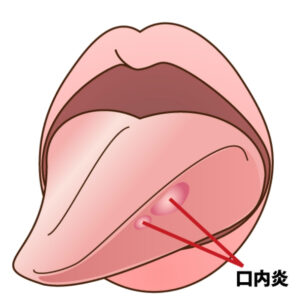 港南台パーク歯科クリニック｜ブログ｜口内炎はなぜできるの？｜アフタ性口内炎①