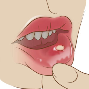 港南台パーク歯科クリニック｜ブログ｜口内炎はなぜできるの？｜アフタ性口内炎③