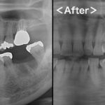 港南台パーク歯科クリニック｜症例｜【【症例】標準的なインプラント治療　38.5万円～（ ストローマン製インプラント＋ジルコニアセラミック ）｜アイキャッチ画像
