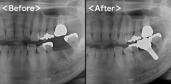 港南台パーク歯科クリニック｜症例｜【【症例】標準的なインプラント治療　38.5万円～（ ストローマン製インプラント＋ジルコニアセラミック ）｜アイキャッチ画像