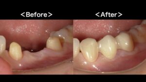 【症例】検診で気づいたはずれかけの金属ブリッジをジルコニアブリッジでやりかえ治療