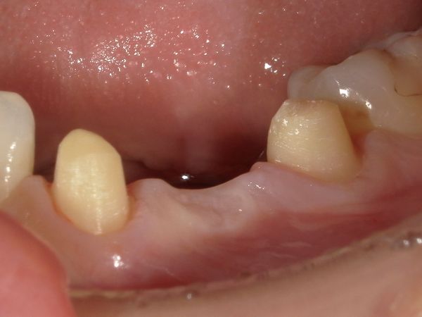 歯の形を整えた後の画像｜【症例】ジルコニアによるブリッジ治療｜港南台の歯医者「港南台パーク歯科クリニック」