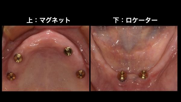 マグネットとロケーター｜【症例】インプラントを用いた総入れ歯の治療｜港南台の歯医者「港南台パーク歯科クリニック」