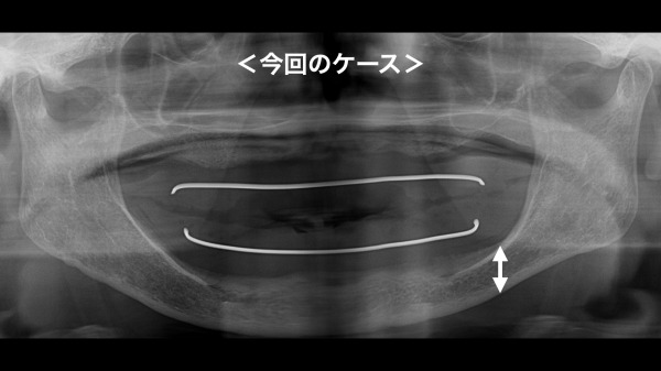 初診時のレントゲン写真｜【症例】インプラントを用いた総入れ歯の治療｜港南台の歯医者「港南台パーク歯科クリニック」