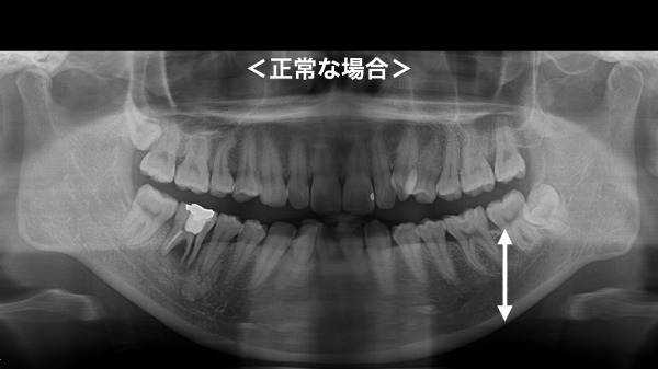 正常な場合のレントゲン写真｜【症例】インプラントを用いた総入れ歯の治療｜港南台の歯医者「港南台パーク歯科クリニック」