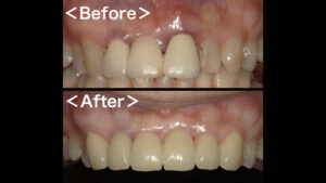 【症例】ジルコニアセラミックブリッジによる前歯の審美治療