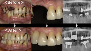 【症例】前歯・奥歯のインプラント治療