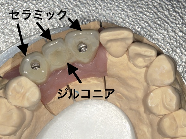 インプラントとジルコニア｜【症例】前歯・奥歯のインプラント治療｜港南台の歯医者 港南台パーク歯科クリニック