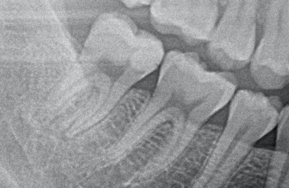 初診時のレントゲン写真|【症例】マイクロスコープを用いた抜髄(神経を取る治療)|港南台の歯医者 港南台パーク歯科クリニック