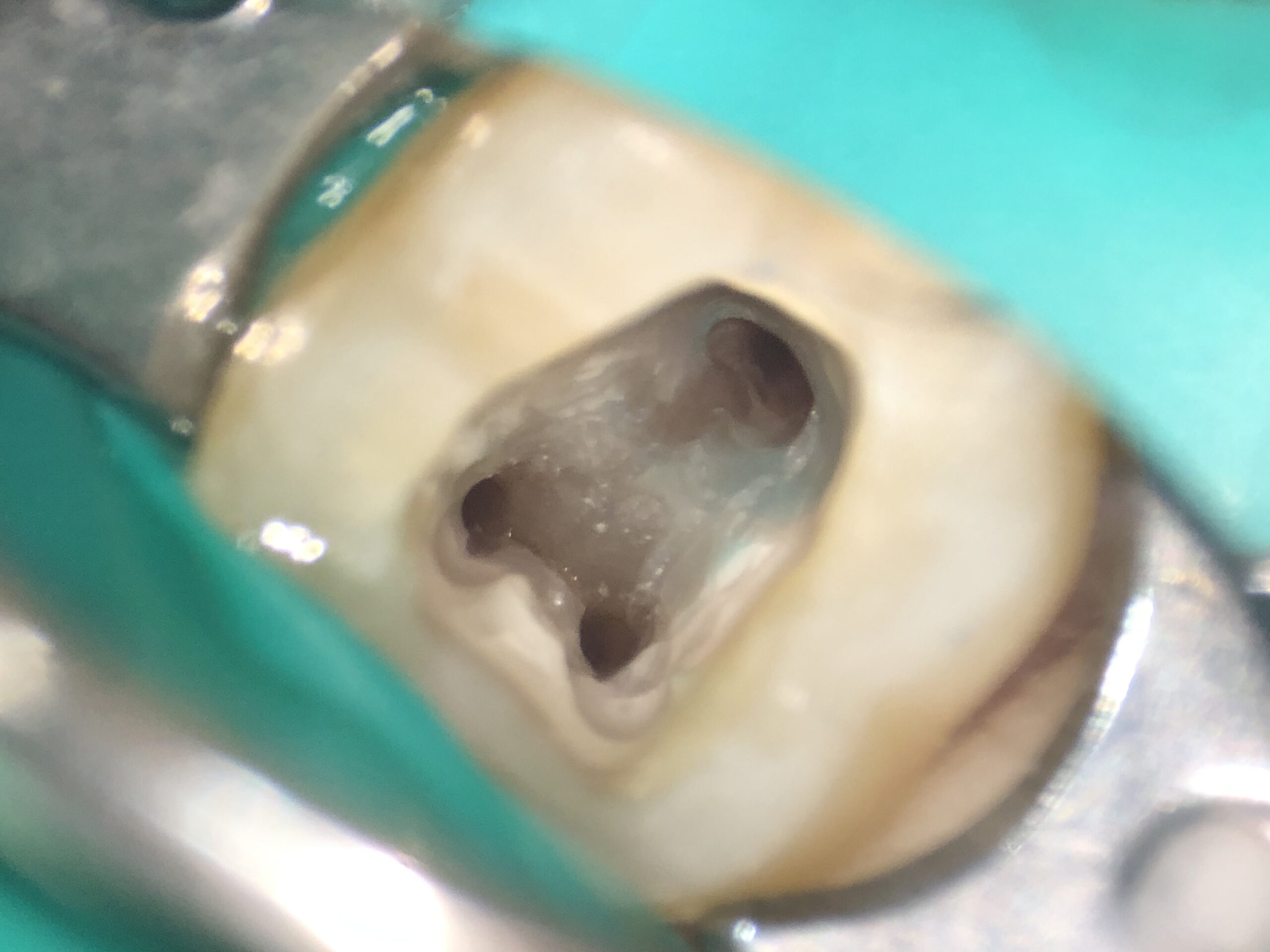 マイクロスコープで見た写真|【症例】マイクロスコープを用いた抜髄(神経を取る治療)|港南台の歯医者 港南台パーク歯科クリニック