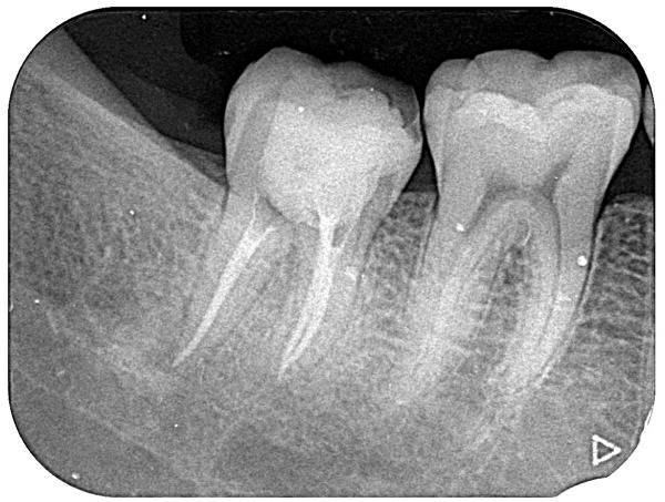 根の先端まで器具が届いているレントゲン写真|【症例】マイクロスコープを用いた抜髄(神経を取る治療)|港南台の歯医者 港南台パーク歯科クリニック