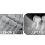 ビフォーアフター画像｜【症例】マイクロスコープを用いた抜髄（神経を取る治療）｜港南台の歯医者 港南台パーク歯科クリニック
