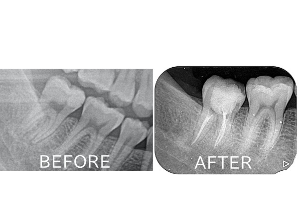 ビフォーアフター画像|【症例】マイクロスコープを用いた抜髄(神経を取る治療)|港南台の歯医者 港南台パーク歯科クリニック